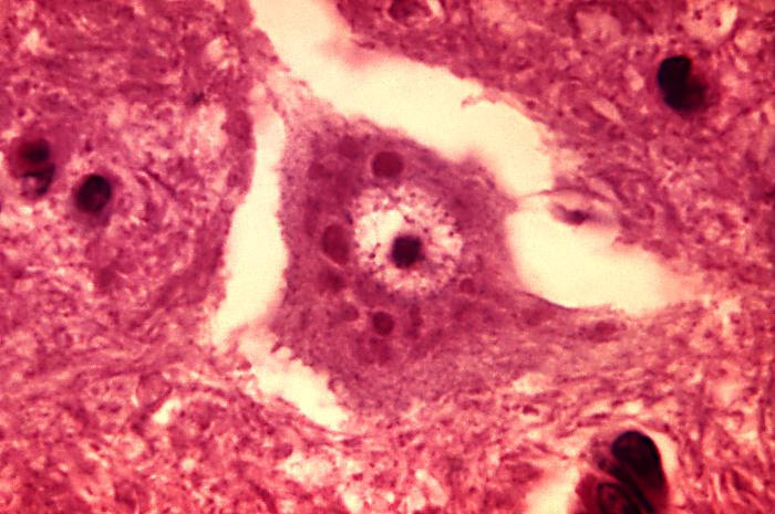 MicrographHistopathologicChangeswithRabiesEncephalitis.jpg